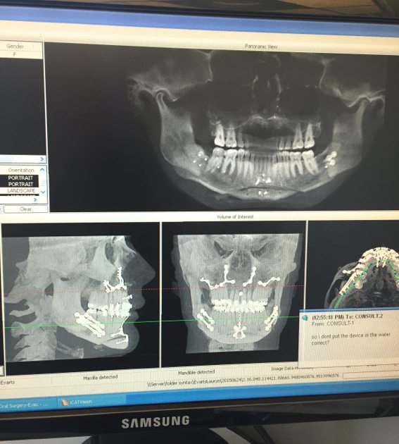 jaw corrective surgery | by the skinny confidential