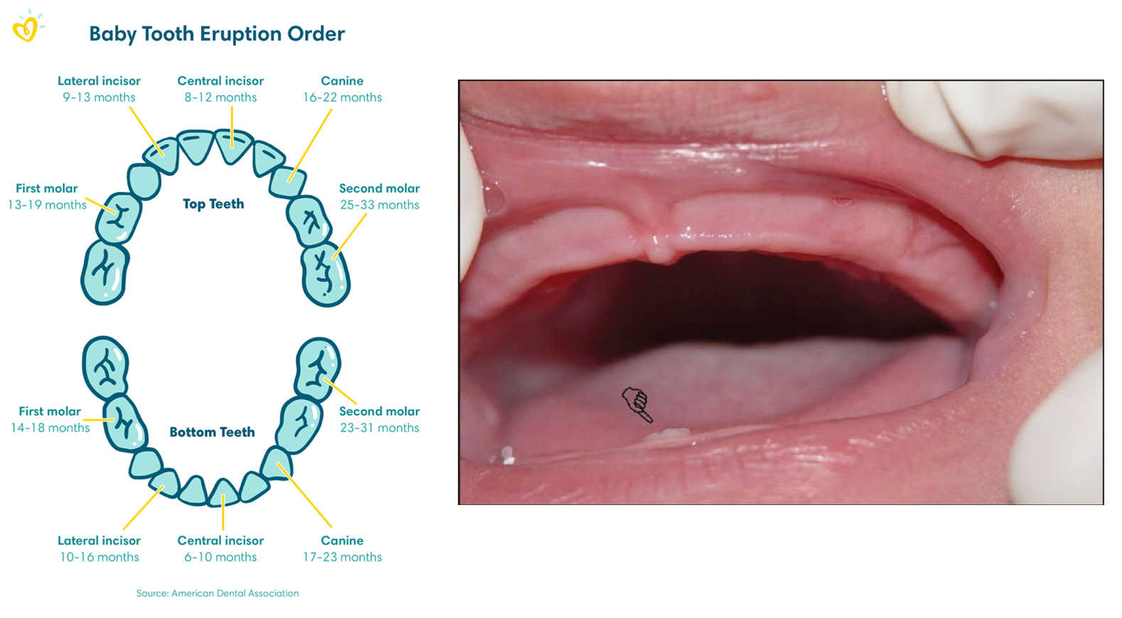Baby tooth eruption order Baby tooth eruption order